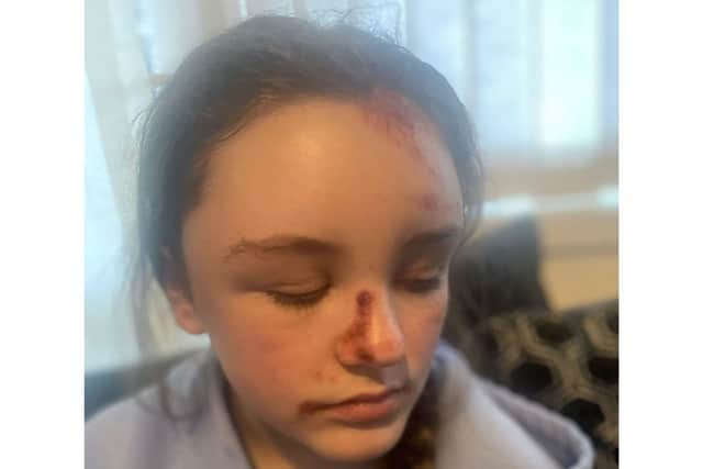 Millie-Rae Herbert was unconscious for 30 minutes following the collision and has been left with broken teeth, a broken nose and various other injuries to her head and body.

Picture: Michelle Price
