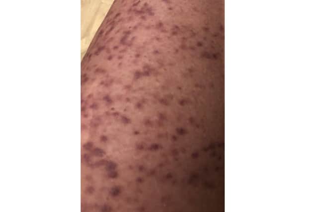 An example of the rash Tracie Temple has caused by systemic mastocytosis