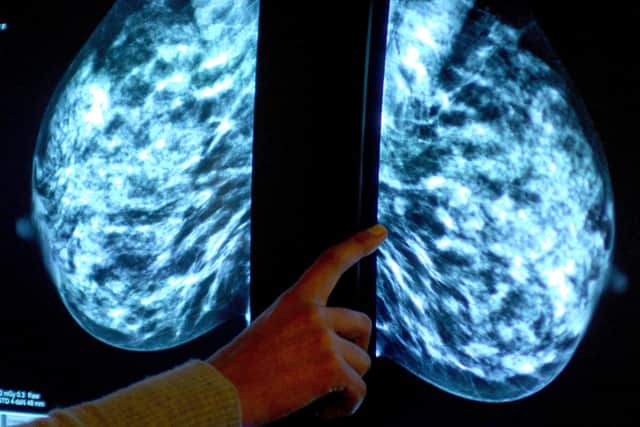 Generic stock picture of a mammogram showing a woman's breast in order check for breast cancer at a hospital.