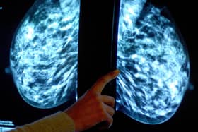 Generic stock picture of a mammogram showing a woman's breast in order check for breast cancer at a hospital.