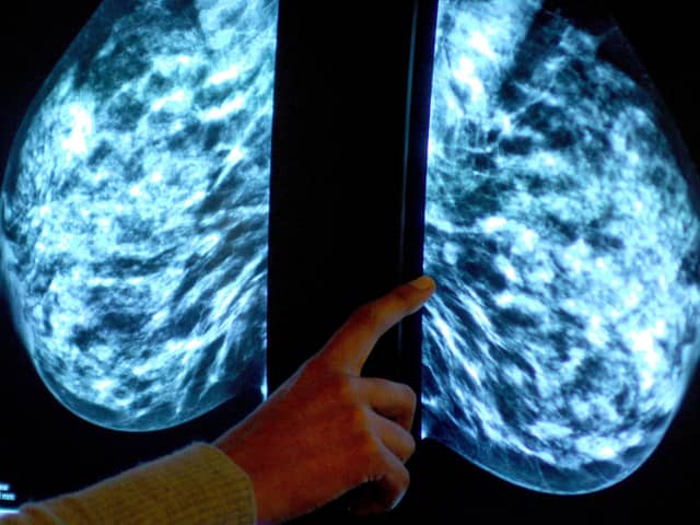 Generic stock picture of a mammogram showing a woman's breast in order check for breast cancer at a hospital.