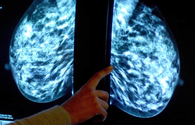 Generic stock picture of a mammogram showing a woman's breast in order check for breast cancer at a hospital.