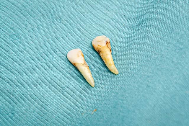 The teeth that Chris Savage pulled out. Picture: Habibur Rahman