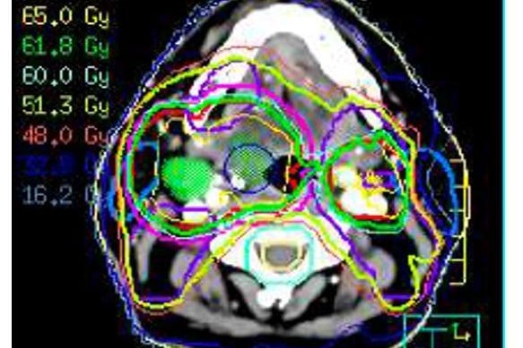 Mandy had a detailed scan to map out her head and neck before receiving a type of radiotherapy called IMRT which precisely shapes the radiation beams to match the tumour shape. Cancer Research UK launched the first UK clinical trial f IMRT in head and neck cancer and proved its benefits in the landmark PARSPORT clinical trial.