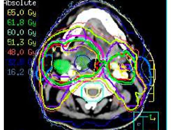 Mandy had a detailed scan to map out her head and neck before receiving a type of radiotherapy called IMRT which precisely shapes the radiation beams to match the tumour shape. Cancer Research UK launched the first UK clinical trial f IMRT in head and neck cancer and proved its benefits in the landmark PARSPORT clinical trial.
