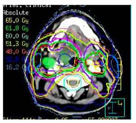 Mandy had a detailed scan to map out her head and neck before receiving a type of radiotherapy called IMRT which precisely shapes the radiation beams to match the tumour shape. Cancer Research UK launched the first UK clinical trial f IMRT in head and neck cancer and proved its benefits in the landmark PARSPORT clinical trial.