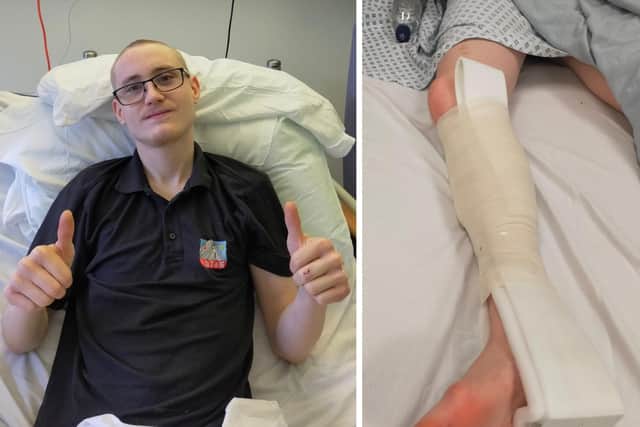 Moped rider Harry Silver broke his right leg in a crash with a car on Hayling Island. Picture: Harry Silver