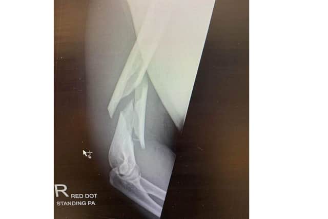 An X-ray from December 2021 showing how Dan Fallon's arm was broken