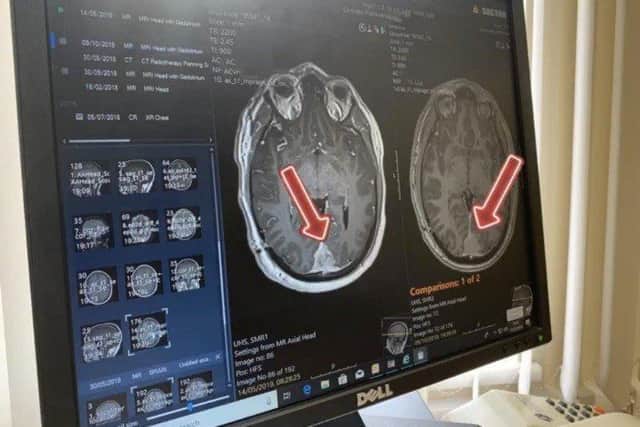 The scan showing Steve's tumour