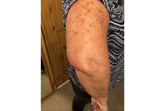 An example of the rash Tracie Temple has caused by systemic mastocytosis