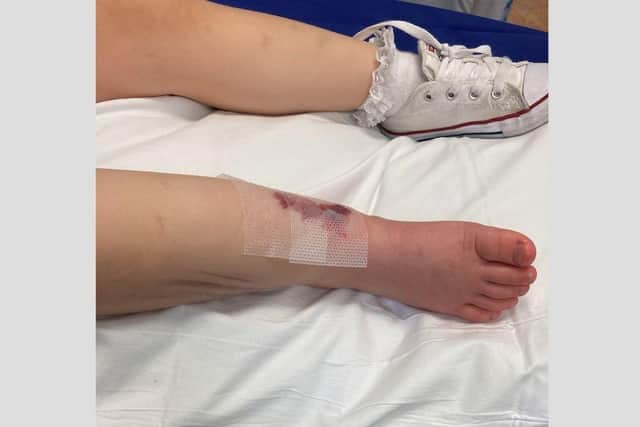Gracie-May's leg after a cast was applied at Queen Alexandra Hospital. Picture: Heidi Reeve