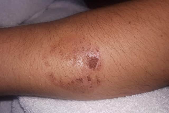 The bite injury caused by Alicia Palmer from Gosport who was given a suspended jail sentence.
