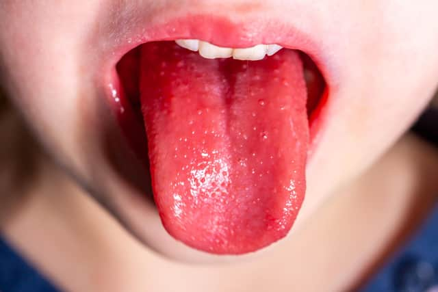 Tongue of a child with scarlet fever - strawberry tongue. Picture: Adobe Stock.