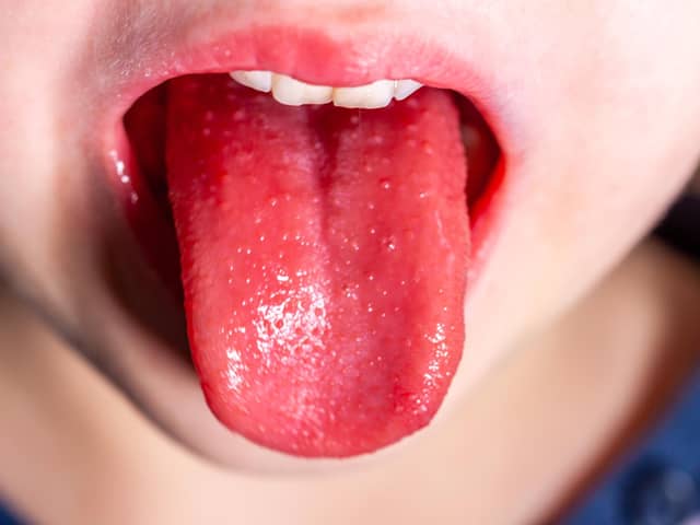 Tongue of a child with scarlet fever - strawberry tongue. Picture: Adobe Stock.