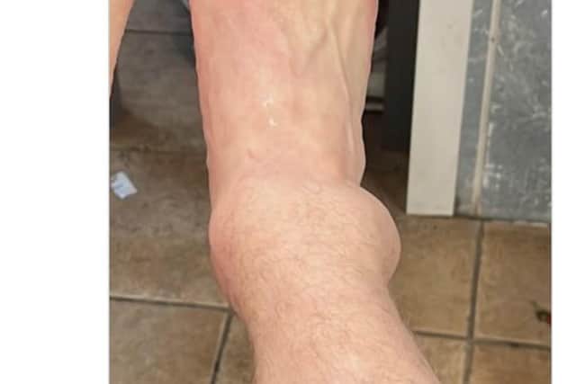 A picture of Ronan Curtis' swollen ankle which has been posted on Twitter by Marie Curtis