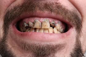 A man pictured with rotten teeth