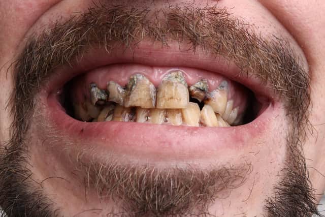 A man pictured with rotten teeth