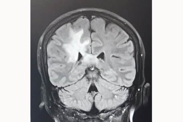 Sharon's brain scan in January 2020.