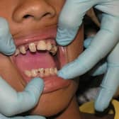 520 people in Portsmouth had to go to A&E due to tooth decay in the past year. Picture: Pixabay