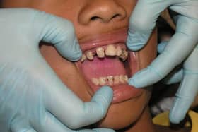 520 people in Portsmouth had to go to A&E due to tooth decay in the past year. Picture: Pixabay