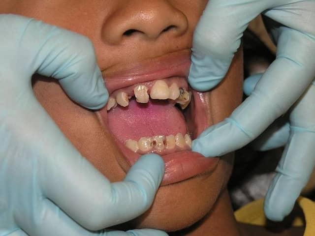 520 people in Portsmouth had to go to A&E due to tooth decay in the past year. Picture: Pixabay