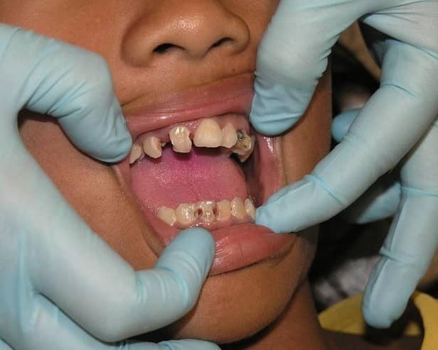 520 people in Portsmouth had to go to A&E due to tooth decay in the past year. Picture: Pixabay