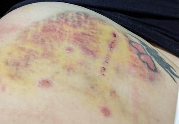 The victim's injured stomach following the suspected XL Bully attack