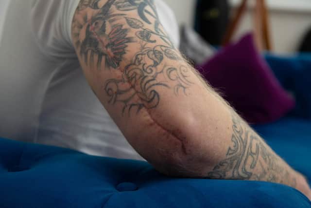 Dan Fallon broke his arm but had to wait 16 days for an operation as it wasn't deemed critical by the NHS. It's healed wonky as a result and he had a botched pin operation which means he may never regain the use of his right arm
Pictured: Dan Fallon at his home in North End, Portsmouth on Tuesday 8th February 2022
Picture: Habibur Rahman
