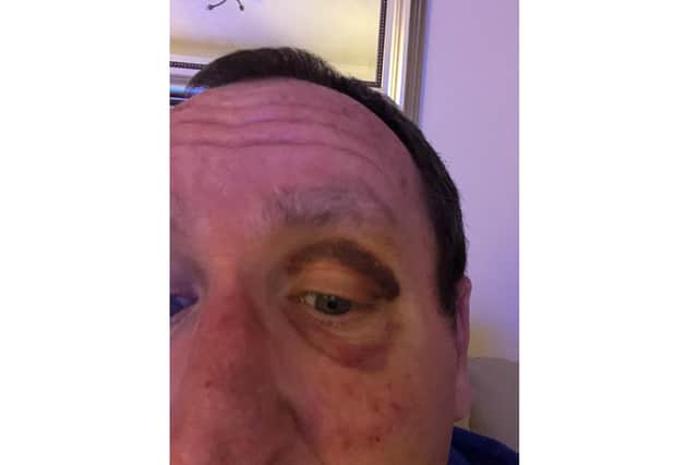 Sean Whelan from Whiteley took on a 300-mile cycle ride for homelessness charity Society of St James. Pictured: Sean's black eye he got at the 11 mile mark from a kerb