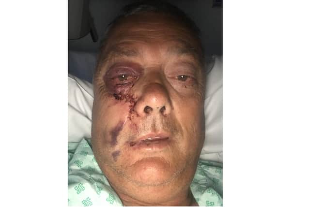 Ross Tyrrell, 63, pictured in hospital after being attacked outside his home in Hayling Island. He was left with a fractured cheek, bleed on the brain and needing stitches to his face and head