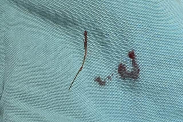 The grass seed removed from Dot's head