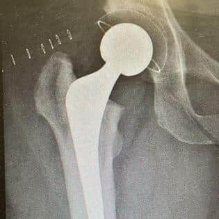 My new hip