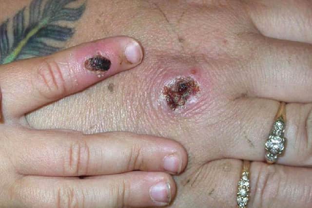 Two cases of Monkeypox have been confirmed in the UK. Photo Courtesy of CDC/Getty Images