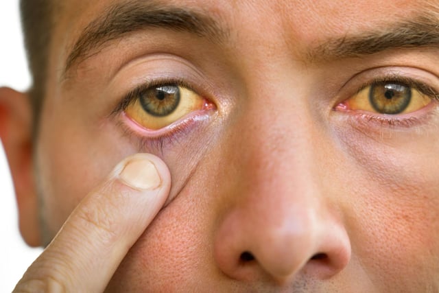 The whites of your eyes, or under your skin, may turn yellow due to a build-up of a substance called bilirubin in your body. This can be caused by various things, including pancreatitis, but could be a sign of pancreatic cancer.