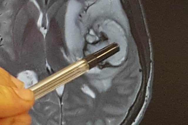 Dan Braiden, 31, of Cosham, near Portsmouth, was diagnosed with a brain tumour a year after successful treatment for testicular cancer
A scan of his tumour
Picture: Brain Tumour Research