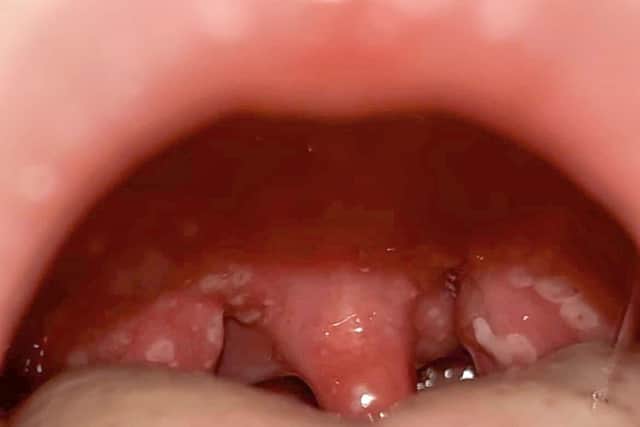 The spots in Jamie Jones's throat after he caught Strep A. See SWNS story SWSMstrepthroat. A mum whose TWO children were hit with Strep A has warned parents the signs to look out for following the death of at least eight children in the UK. Aimee Byron, 22,a stay-at-home mum said son Jamie Jones, three, became tired and started screaming in pain, holding his head saying he had "tickles in his throat". It was covered in white big spots and doctors told Aimee he was suffering from tonsillitis, she said. But after a few days of suffering, she tool him back to the GP where he was diagnosed with strep A and taken to Queen Alexandra Hospital for treatment. But just a day after he returned home, little brother Drew, 17 months, was diagnosed with the same bacterial infection, after catching it from Jamie. :A mum whose TWO children have Strep A has warned parents of the signs following the death of at least eight children in the UK.
Aimee Byron, 22, a stay-at-home mum said son Jamie Jones, three, became tired and started screaming in pain, holding his head saying he had "tickles in his throat".
It was covered in white big spots and doctors told Aimee he was suffering from tonsillitis, she said.
But after a few days of suffering, she took him back to the GP where he was diagnosed with strep A and taken to hospital for treatment.