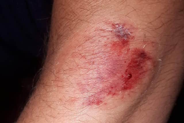 The bite injury caused by Alicia Palmer from Gosport who was given a suspended jail sentence.