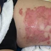The child sustained serious burns and spent weeks in hospital.