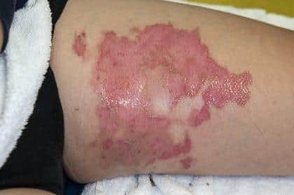 The child sustained serious burns and spent weeks in hospital.