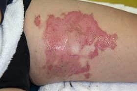The child sustained serious burns and spent weeks in hospital.