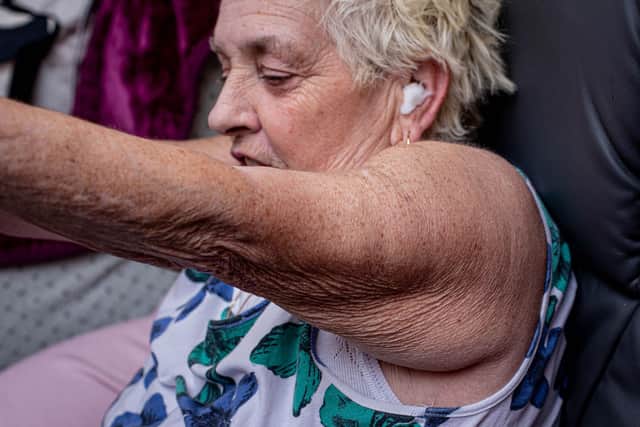 Linda Sumner and her arm injury. Picture: Habibur Rahman