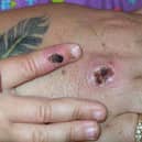 There have been numerous confirmed cases of monkeypox in the UK.