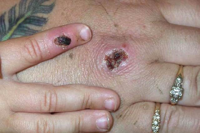 There have been numerous confirmed cases of monkeypox in the UK.
