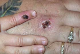 There have been numerous confirmed cases of monkeypox in the UK.