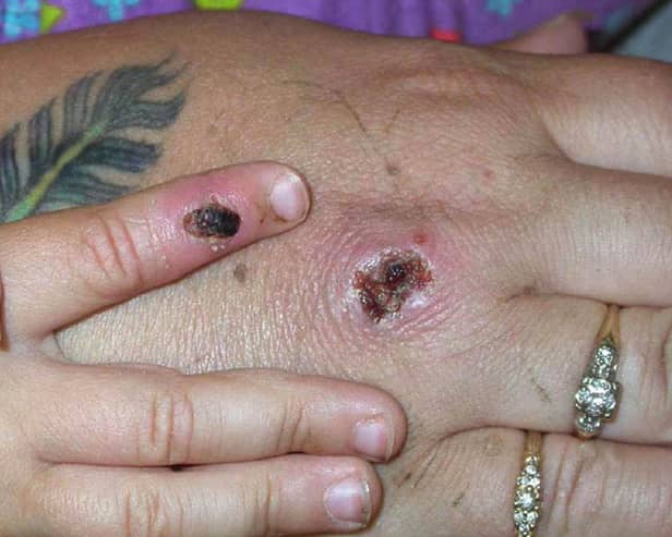 There have been numerous confirmed cases of monkeypox in the UK.