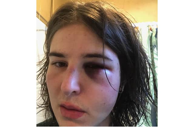 Danny Fletcher, 18, pictured after the assault.