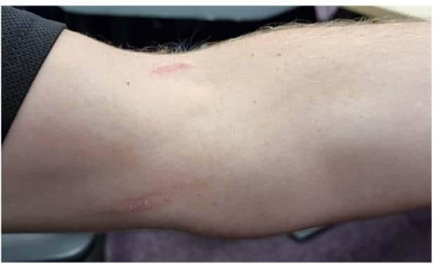 The injury to PC Andrew Holmes caused by Matthew Wagstaff. Picture: CPS Wessex