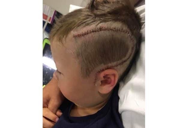 Shay Glenton, 8 from Lee-on-the-Solent, will be cycling for two hours straight to raise money for University Hospital Southampton which has cared for him since his diagnosis of epilepsy and subsequent brain surgery. Pictured: Shay's head following his surgery