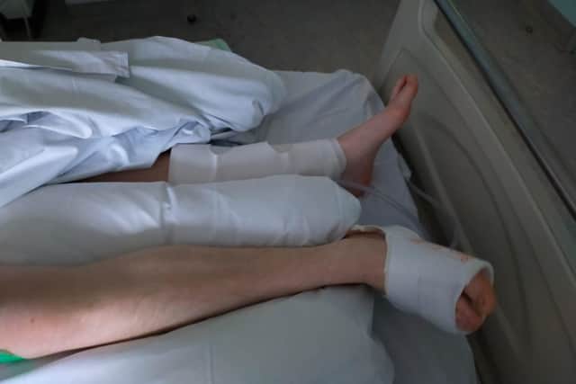 Moped rider Harry Silver broke his right leg in a crash with a car on Hayling Island. Picture: Harry Silver