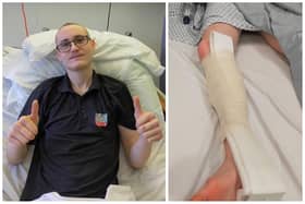 Moped rider Harry Silver broke his right leg in a crash with a car on Hayling Island. Picture: Harry Silver